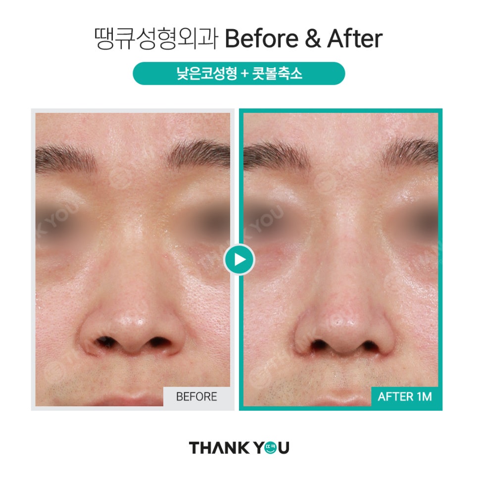 코 재수술시 기존 실리콘은 꼭 제거해야 되나요? 관련 이미지 8