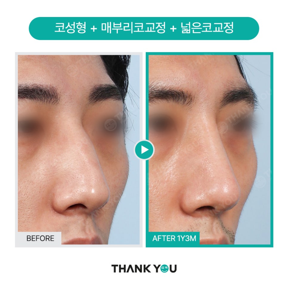 신논현역 성형외과, 남자 휜코성형, 매부리코 성공 포인트는? 관련 이미지 8