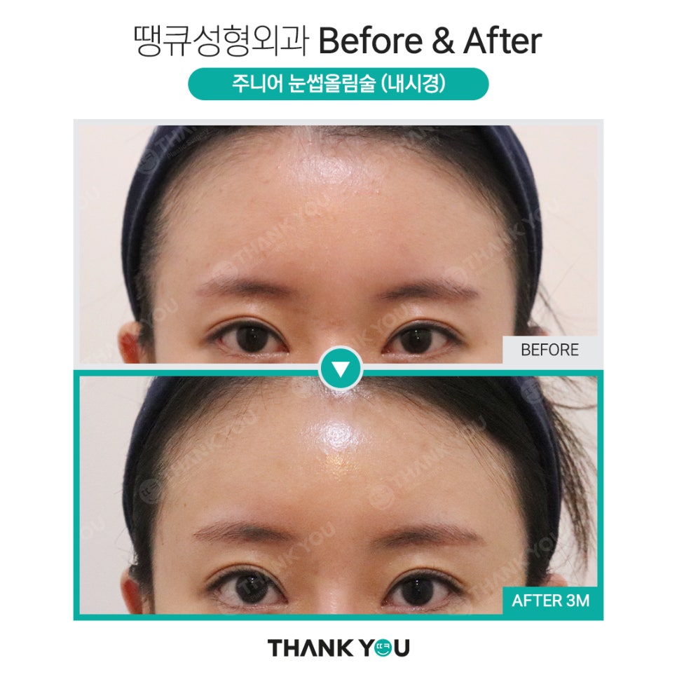 나이가 어린데도 이마거상을 꼭 해야 할까요? 관련 이미지 7