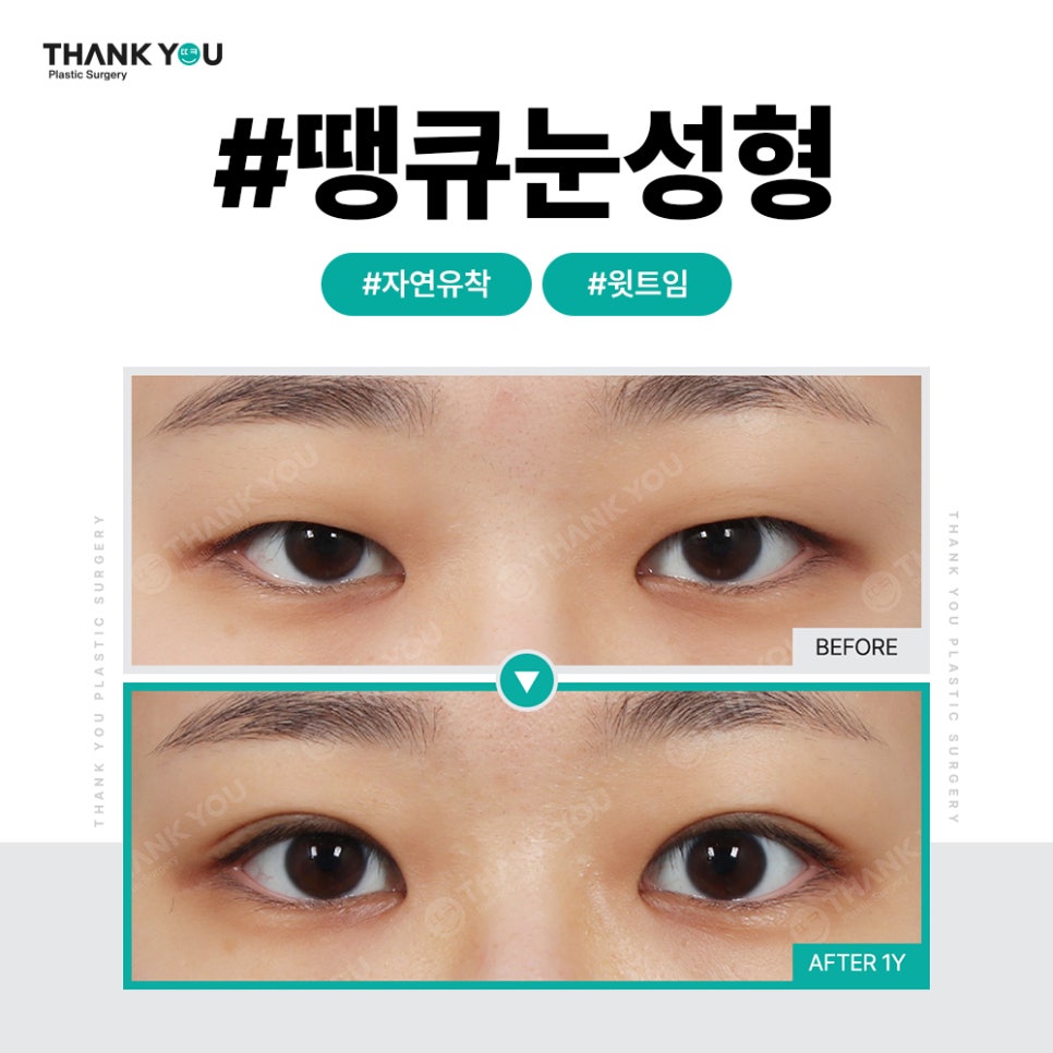 쌍꺼풀 라인 종류, 내게 맞는 쌍수랑 트임은?(인라인) 관련 이미지 10