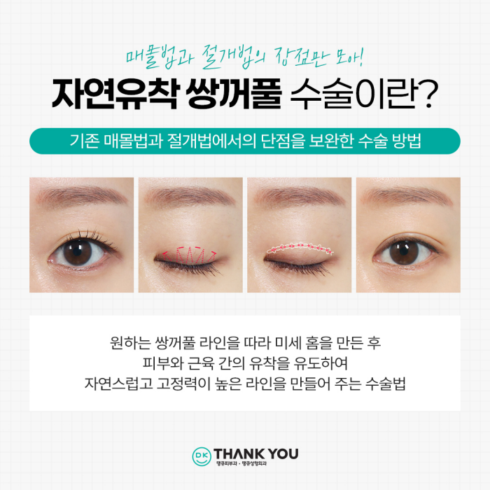 인아웃라인쌍커풀 자연유착매몰 방식으로 예쁘게! 관련 이미지 2
