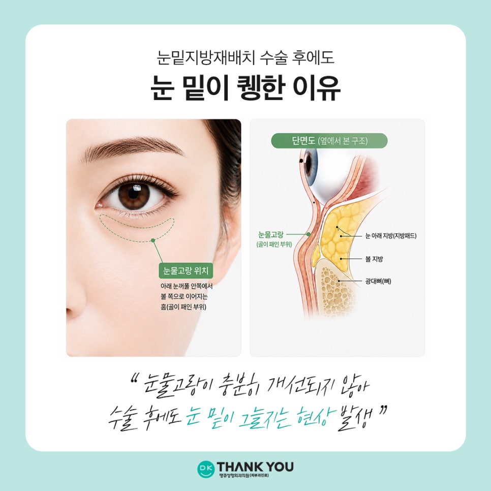 Still Hollow Under the Eyes After Lower Eyelid Fat Repositioning? The Need for Microfat Grafting Under the Eyes image 3