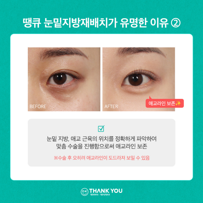 눈밑꺼짐수술? 눈밑지병원에서 내게 딱 맞게! 관련 이미지 8