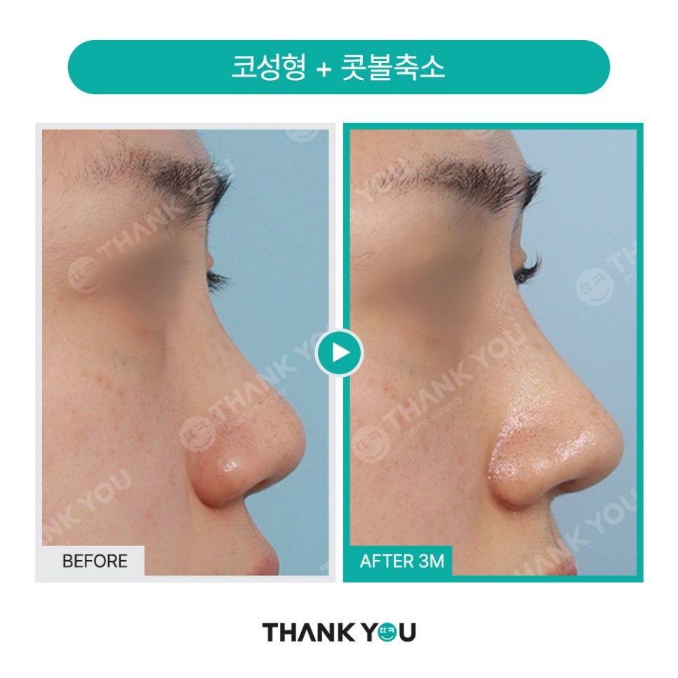 이런 코는 무조건 성공?! 코성형 성공 유형 관련 이미지 12