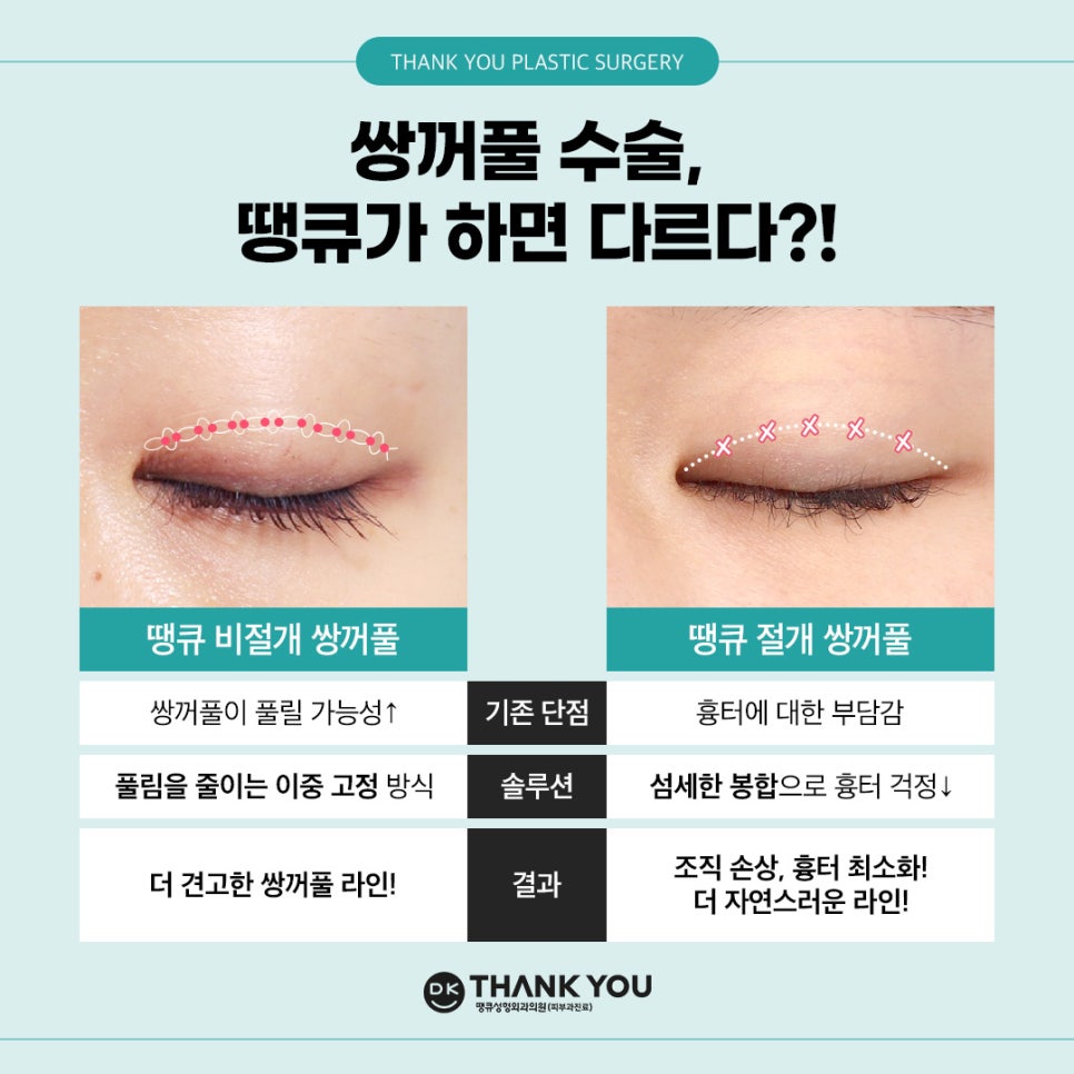 쌍꺼풀잘하는병원 땡큐에서 알려주는 절개vs비절개 수술법의 특징! 관련 이미지 7