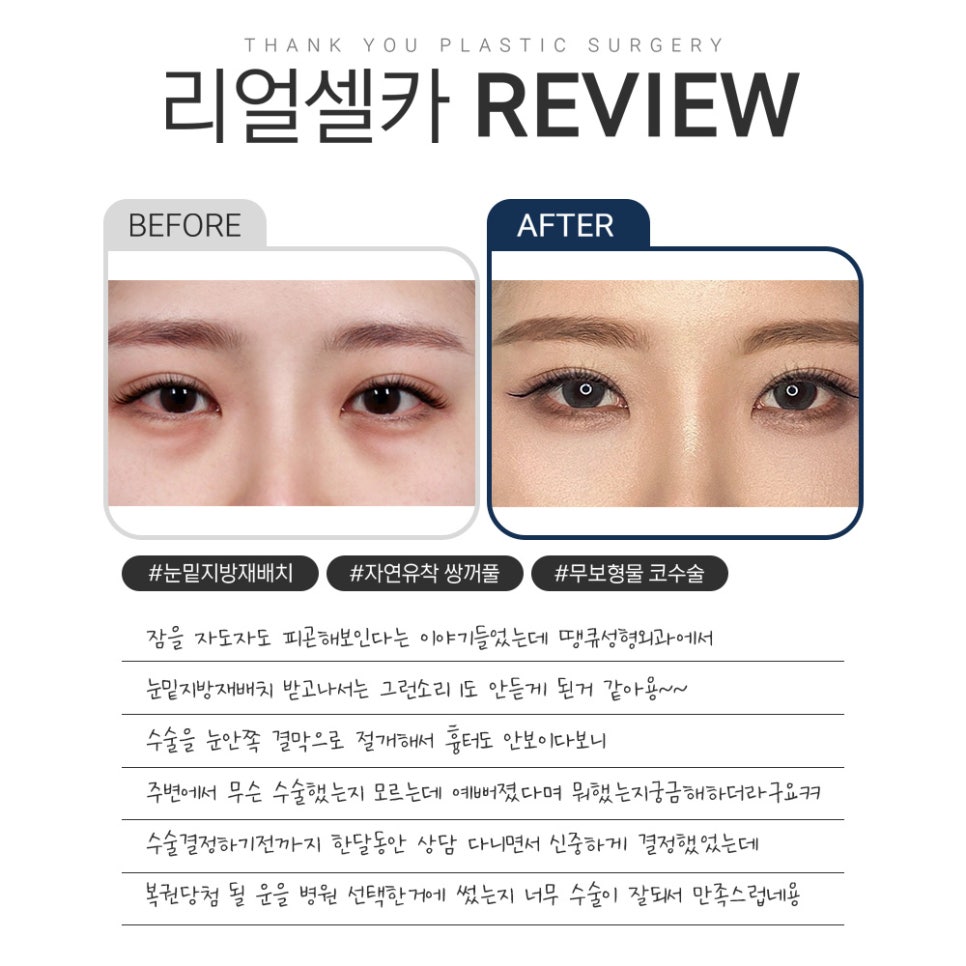 땡큐 다크서클 수술&눈밑지방재배치 리얼셀카  𝐑𝐄𝐕𝐈𝐄𝐖 관련 이미지 4