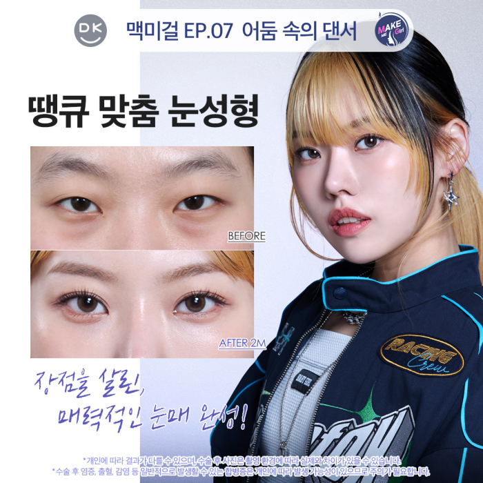 Improving Small, Faint Eyes with Non-Incisional Eye Correction Surgery ✨ (Make Me Girl Episode 7 Thank You Solution) image 1