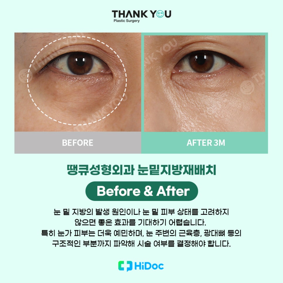 (눈밑지방불룩함)눈 지방 볼록한 이유or눈밑지 수술후 주의사항 관련 이미지 8