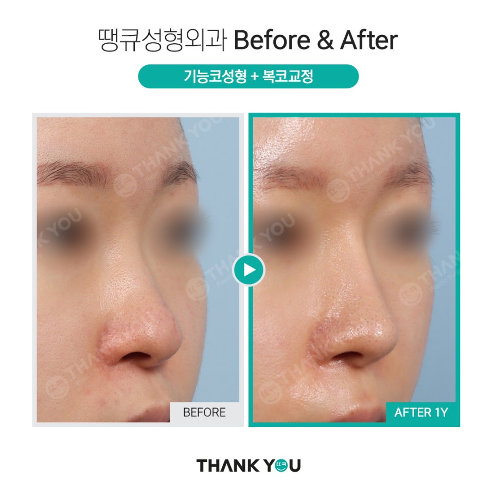 강남 코성형 전후, 코수술 잘하는 곳? 관련 이미지 4