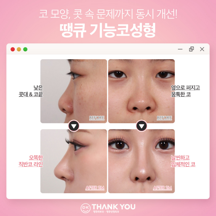 땡큐성형외과, 맥미걸 솔루션! 하비갑개수술 X 미용코, 기능&middot;미용 개선을 동시에! 관련 이미지 6