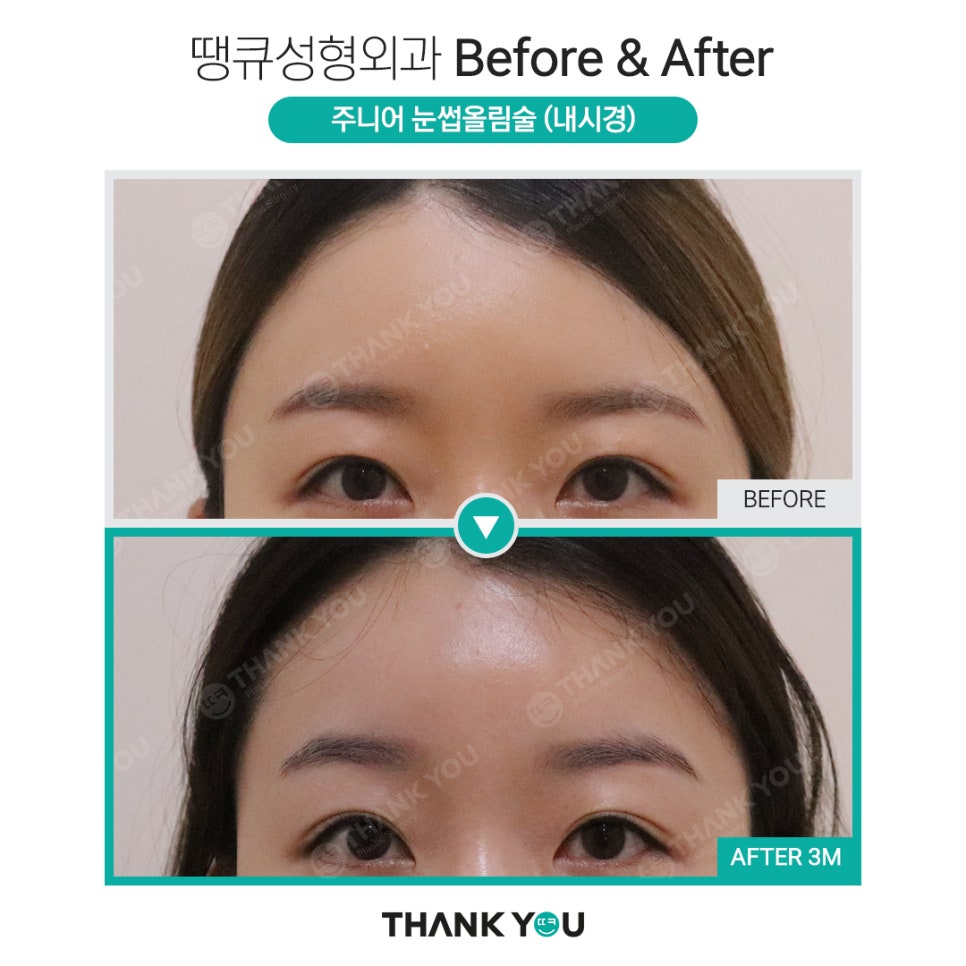 나이가 어린데도 이마거상을 꼭 해야 할까요? 관련 이미지 11