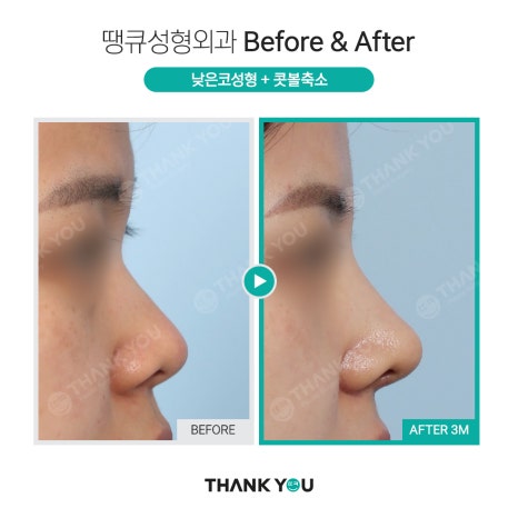 복코 수술&뭉툭한 코 교정👃직원도 믿고 코성형하는 땡큐 관련 이미지 18