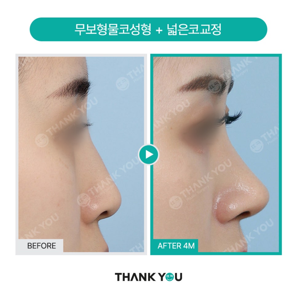 넓은코, 큰코성형 매부리코교정 찾는다면? 관련 이미지 11