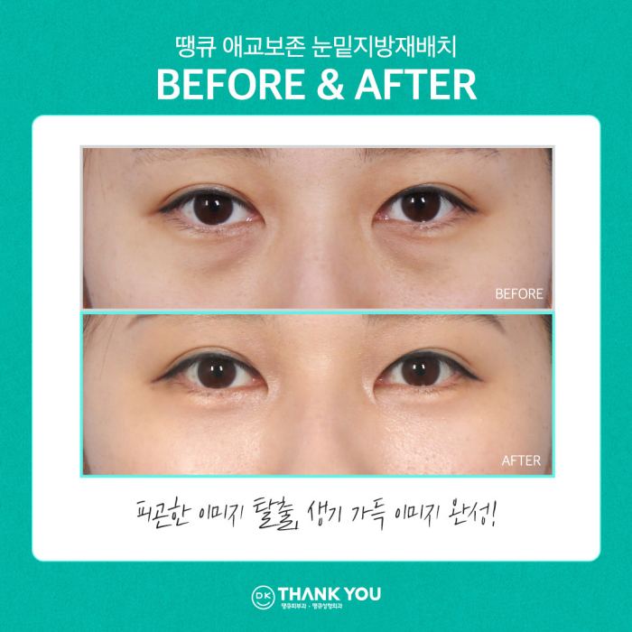 눈밑꺼짐수술? 눈밑지병원에서 내게 딱 맞게! 관련 이미지 9