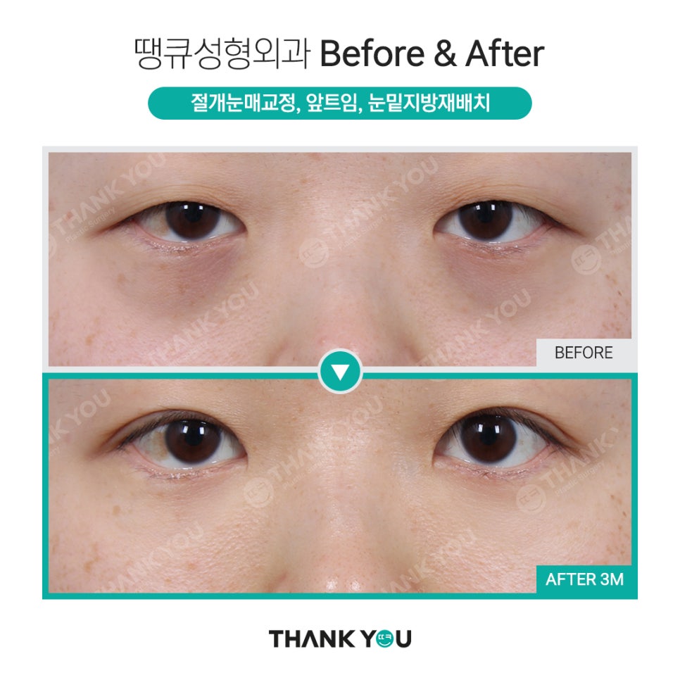 눈밑지 지방이식? 앞광대지방이식 필요한 이유? 관련 이미지 11