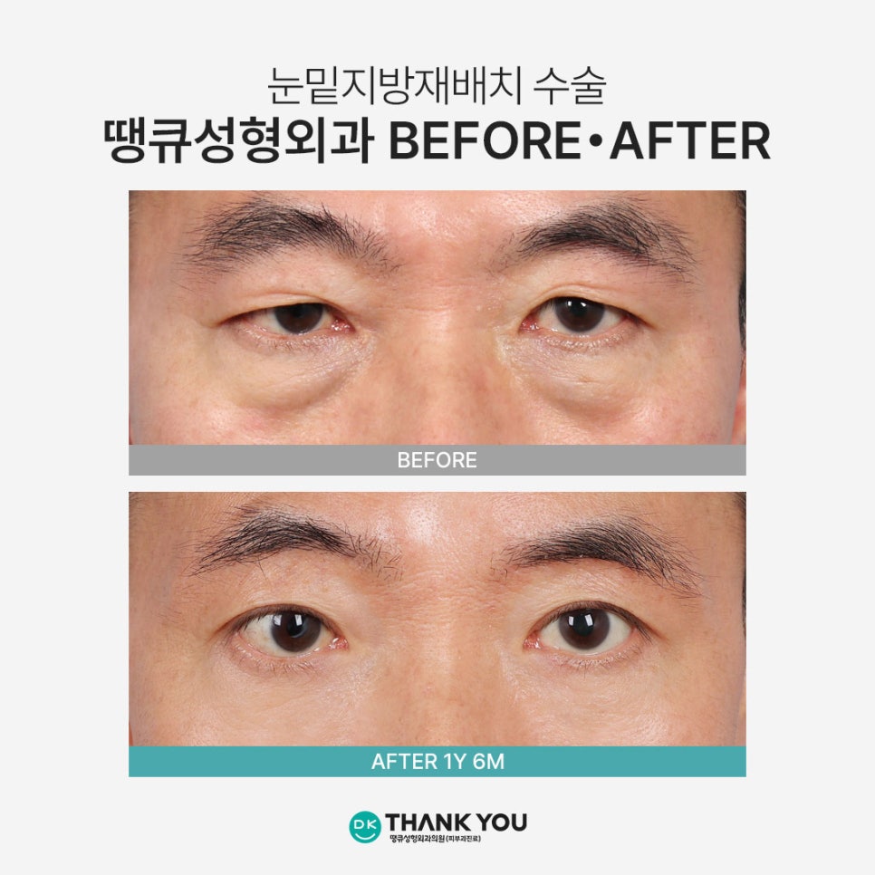 눈밑지방재배치 재발? 수술 후 눈 밑이 볼록한 이유 관련 이미지 4