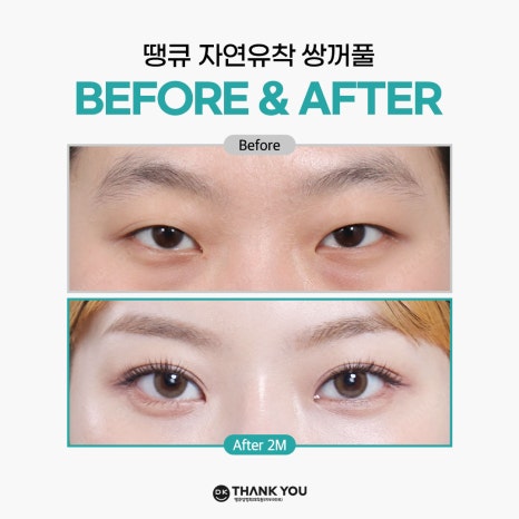 쌍꺼풀잘하는병원 땡큐에서 알려주는 절개vs비절개 수술법의 특징! 관련 이미지 8