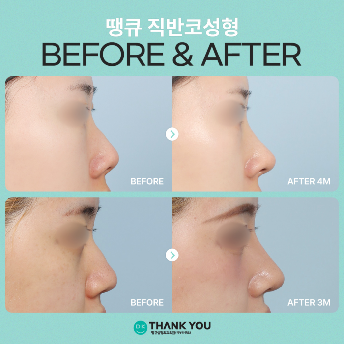 A Sophisticated Nose Line Completed with Semi-Straight Nose Surgery! image 8