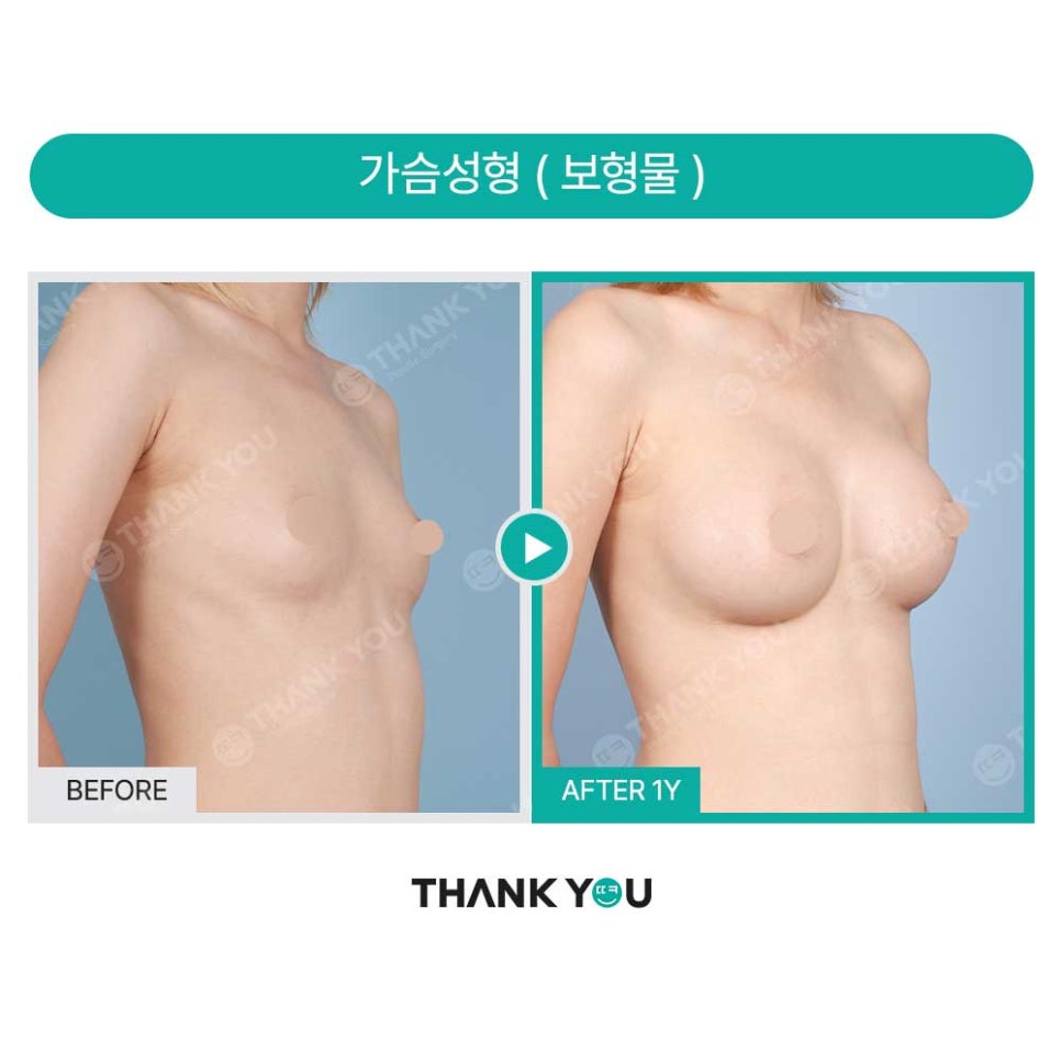 자연스럽고 트렌디한 가슴수술, 모티바 전용룸에서 (가슴 전후) 관련 이미지 19