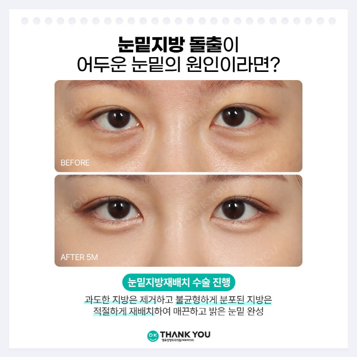 눈밑지수술 효과로 밝은 눈밑, 동안 외모 완성! 관련 이미지 3