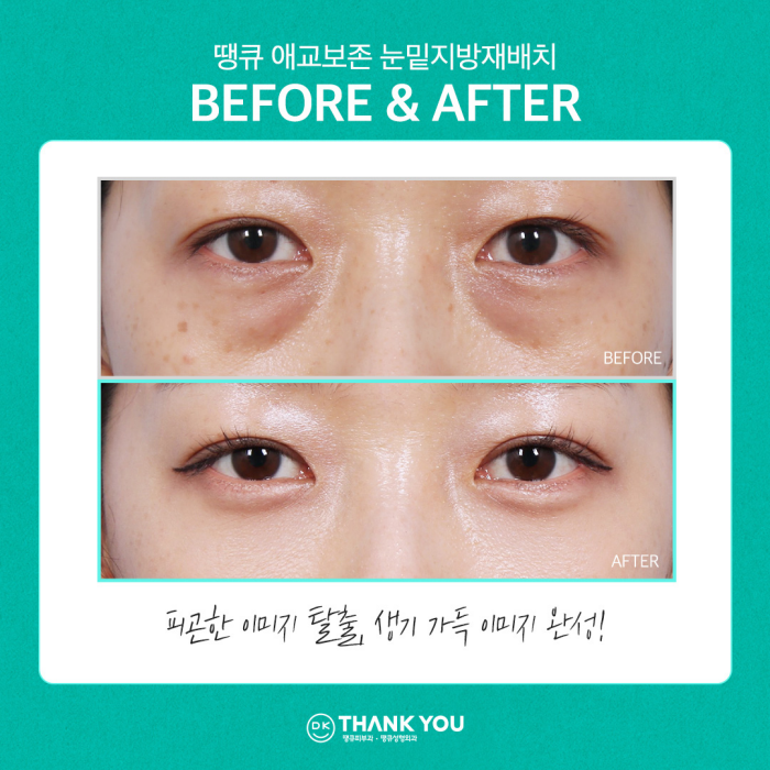 눈밑꺼짐수술? 눈밑지병원에서 내게 딱 맞게! 관련 이미지 3