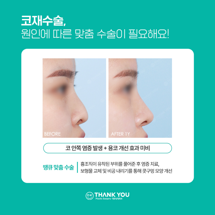 코재수술병원에서 알려주는 재수술하게 되는 이유! 관련 이미지 4