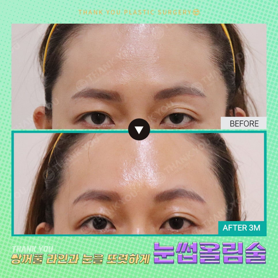 쌍수에 눈썹올림술을 추천하는 이유?! 관련 이미지 24