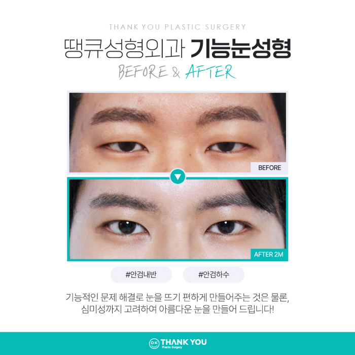 기능눈성형 근본적인 원인을 개선해야 해요! 관련 이미지 8