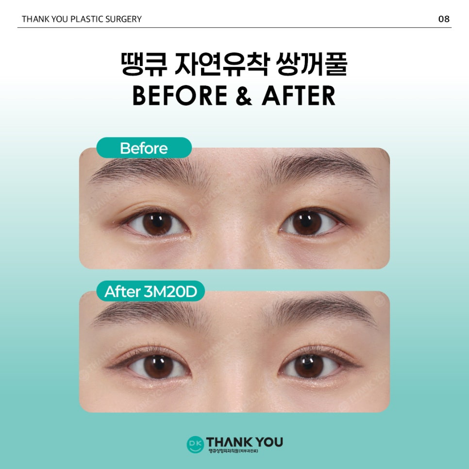 Natural Adhesion Double Eyelid Surgery Done Well: Naturally, as if It Were Meant to Be, at Thank You! image 9