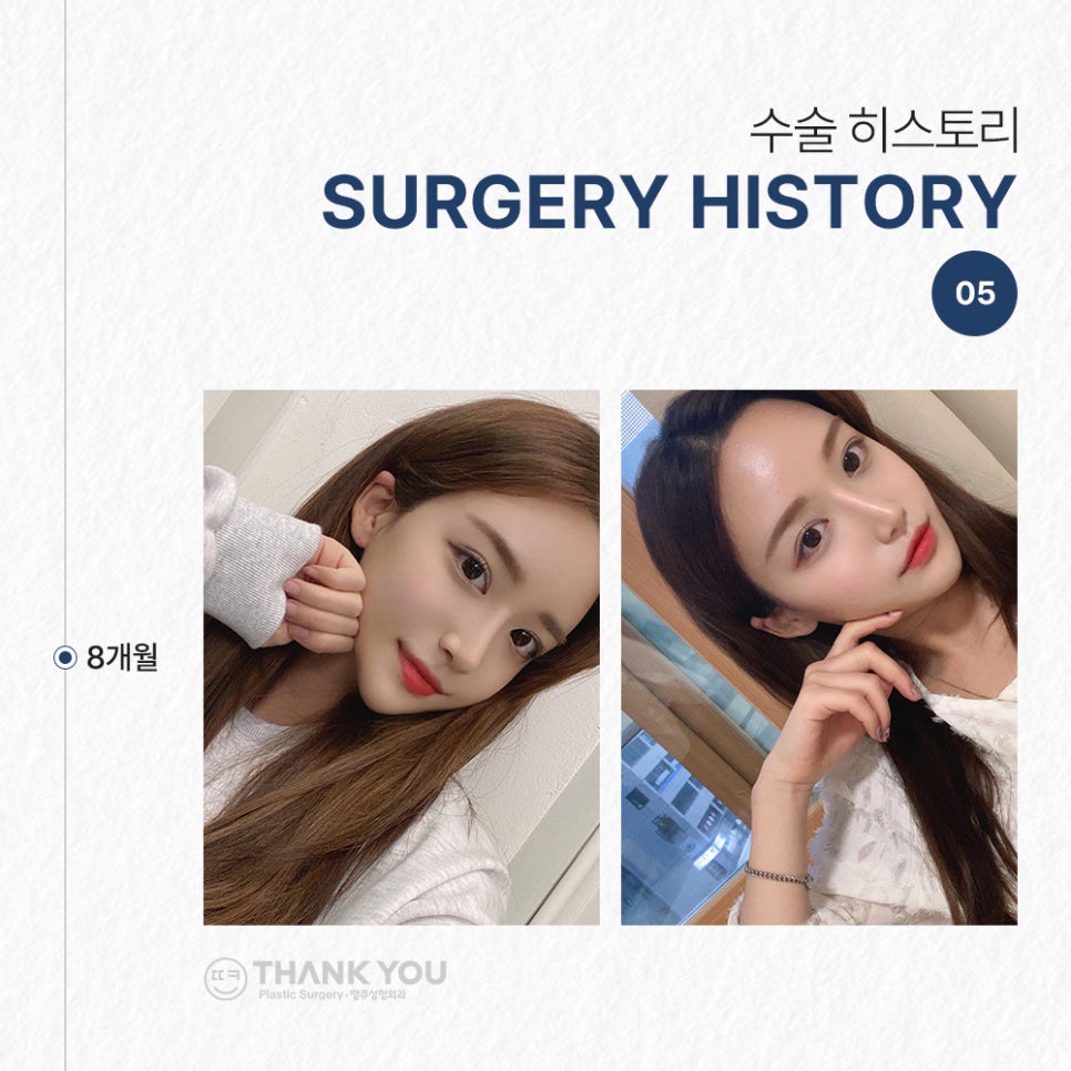 눈코성형 같이 하고싶다면? (자연유착 윗트임+콧불축소) 관련 이미지 9
