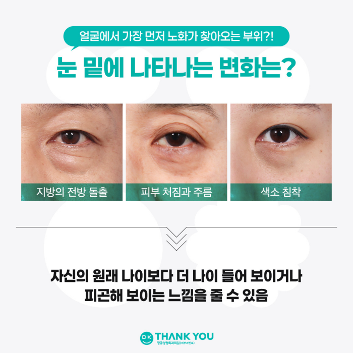 눈밑성형수술 만족도를 높이는 방법은? 관련 이미지 2