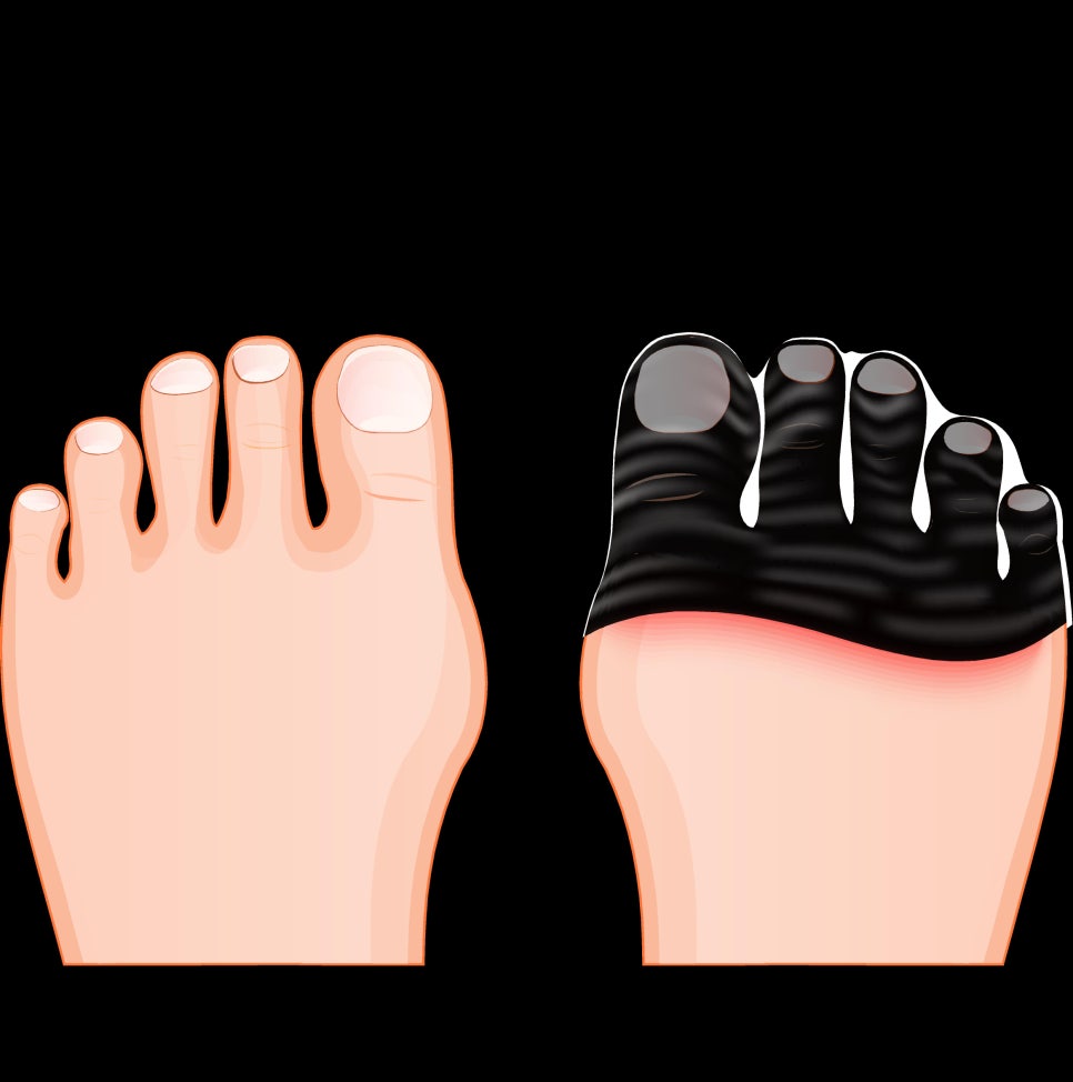 눈밑 수술, 혈류 보존이란? 관련 이미지 3