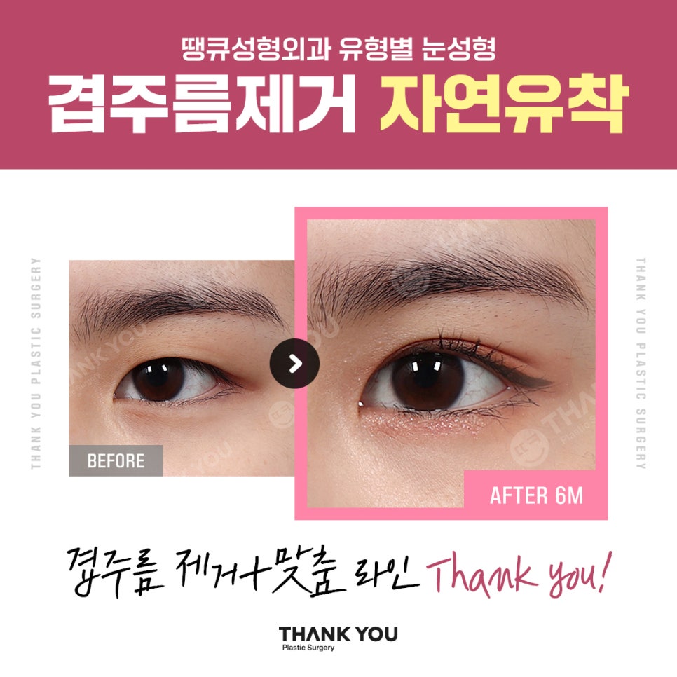 신논현역 성형외과에서 쌍수 전후 Check✨ 관련 이미지 10