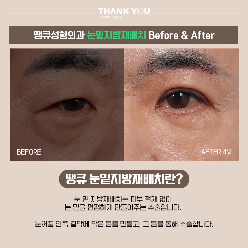 프리미엄 눈밑지방재배치(원데이)란? 땡큐 이호준 원장님 관련 이미지 4