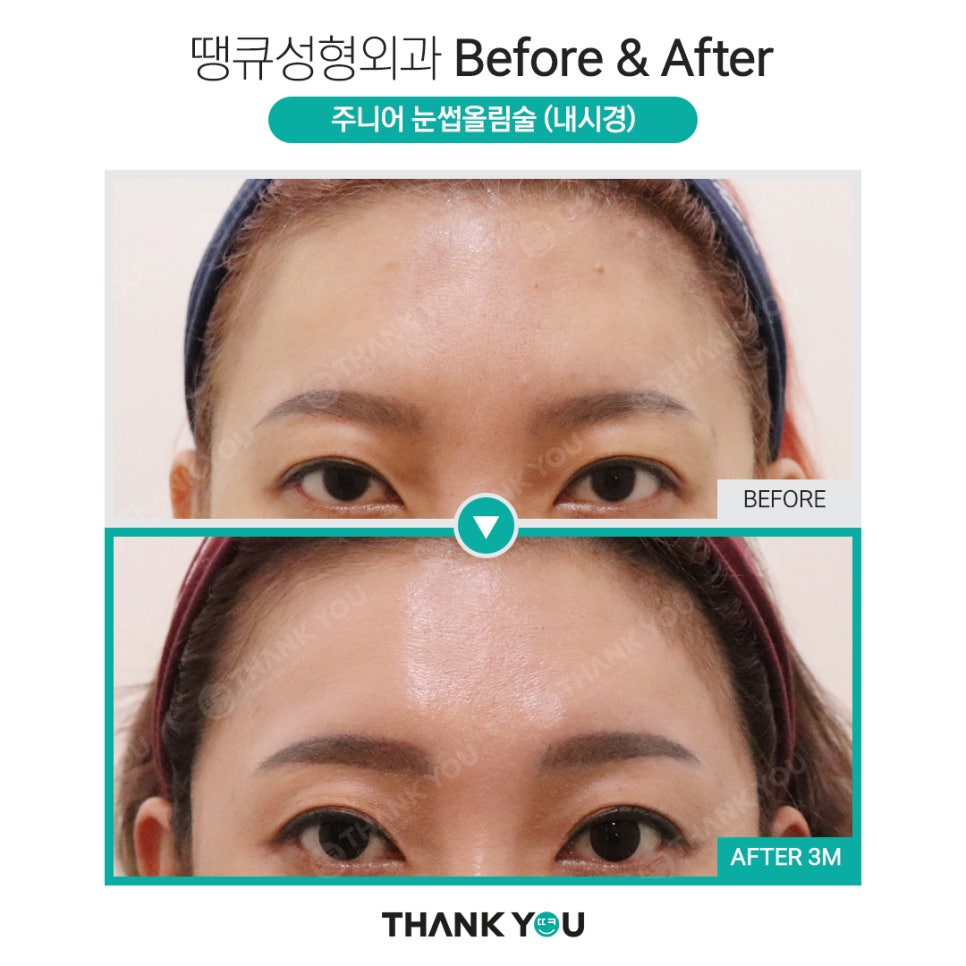 나이가 어린데도 이마거상을 꼭 해야 할까요? 관련 이미지 8