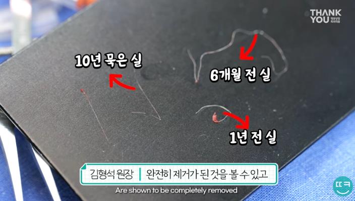 눈꺼풀에 딱딱한 여드름? 육아종 제거 [비절개] 관련 이미지 13