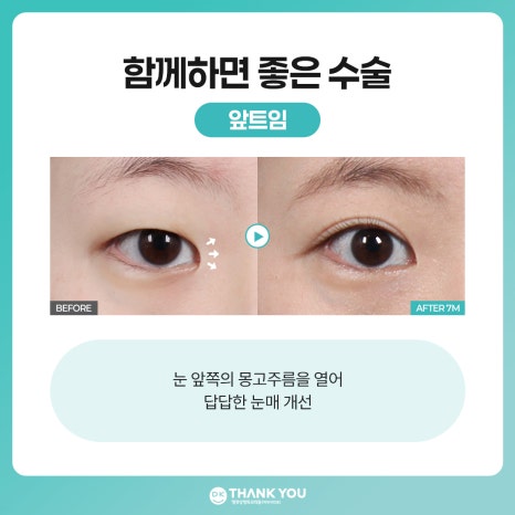 비절개 눈매교정 vs 절개 눈매교정 뭐가 다를까? 관련 이미지 10