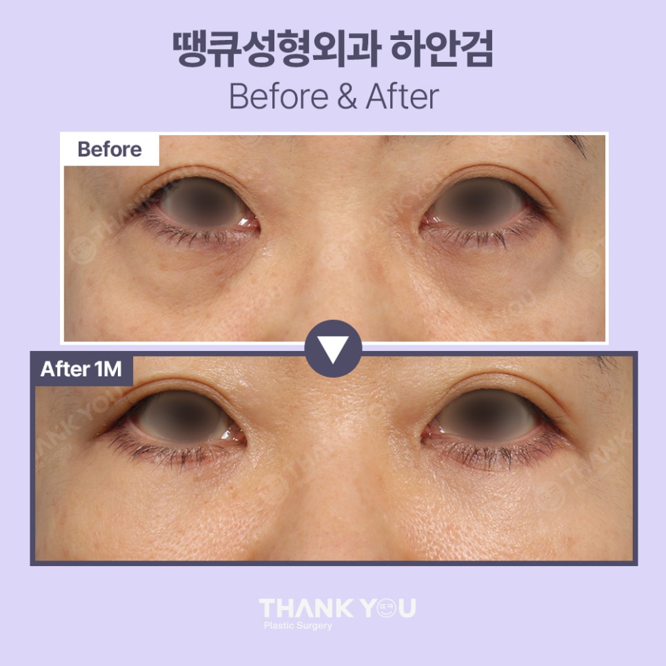 눈밑하안검수술 전후사진 확인, 땡큐 이호준 원장님 관련 이미지 7