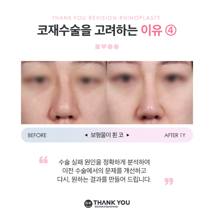 코재수술잘하는병원 땡큐 이벤트✨ 관련 이미지 5