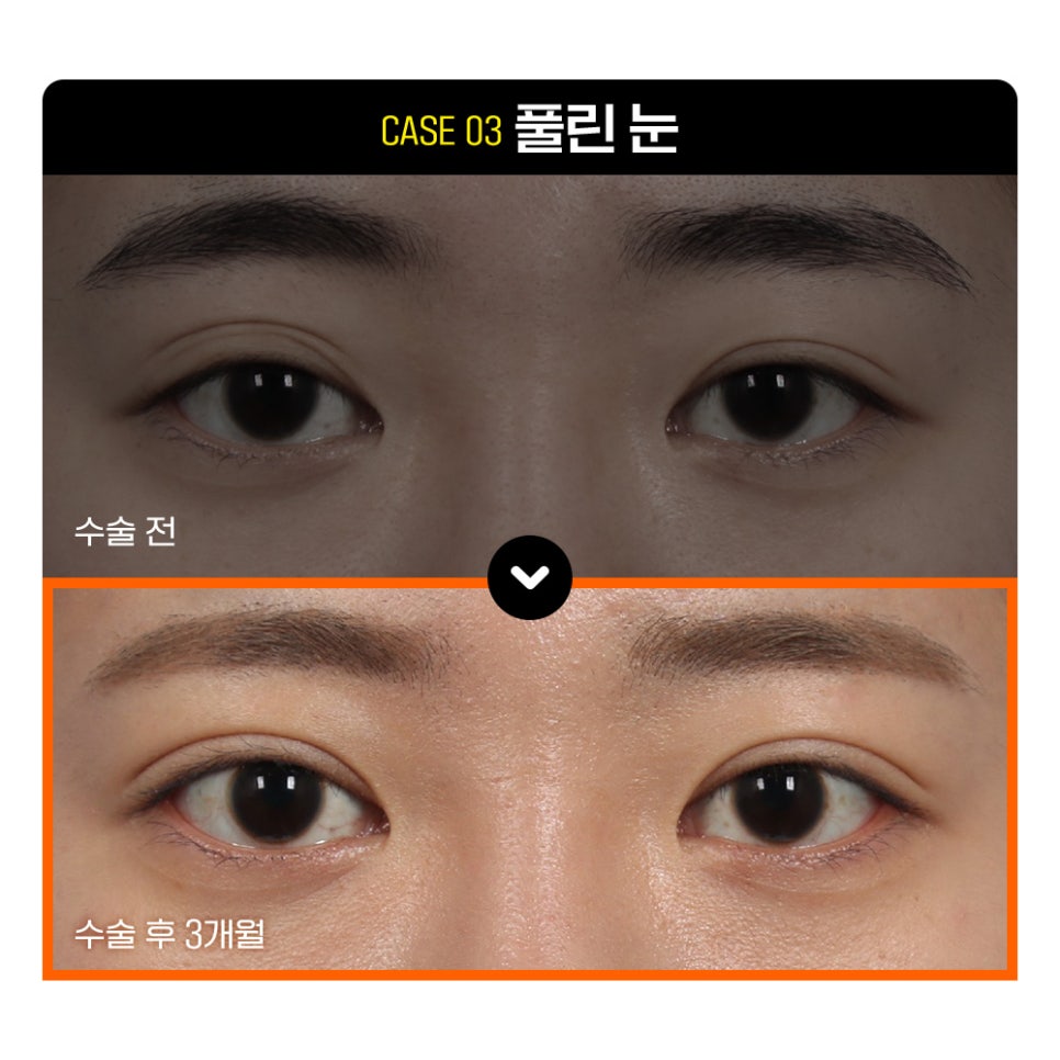 강남 눈재수술, THANK YOU기존 쌍꺼풀라인 풀기 관련 이미지 5