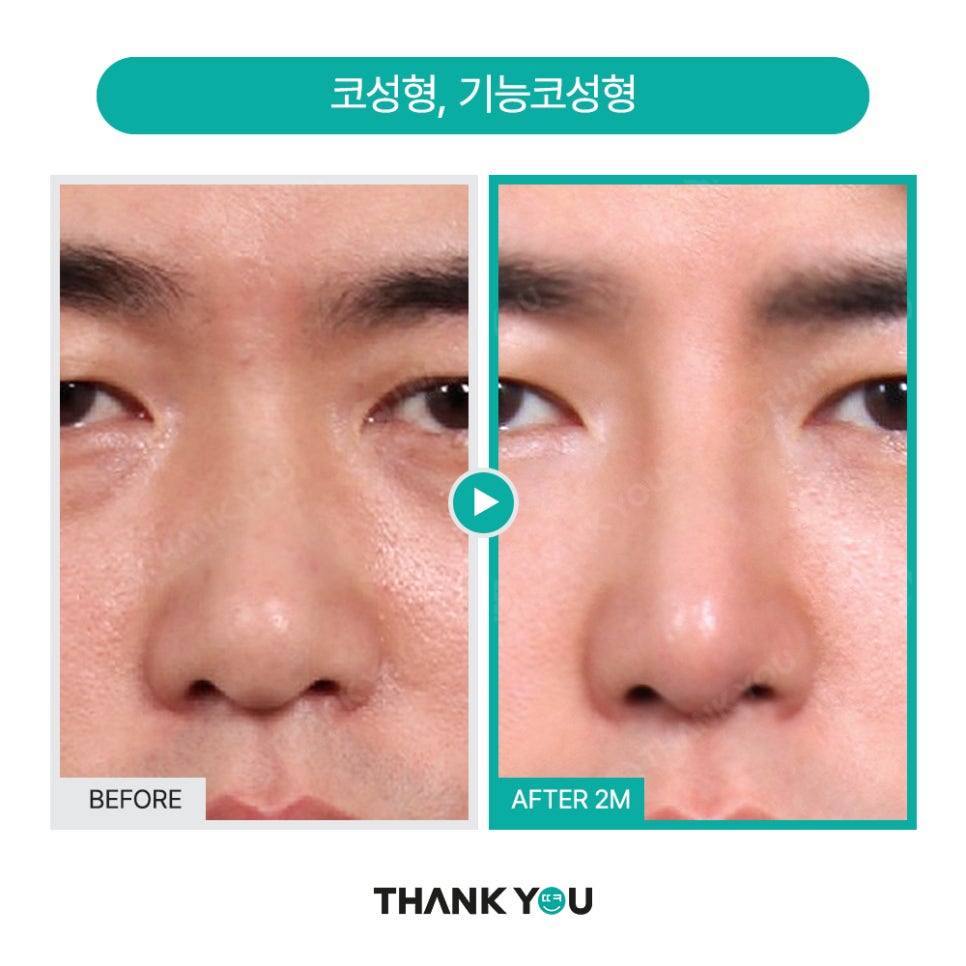 MAKE미남(맥미남) 오덕차장님의 노안 개선&남자 비염코성형 전후 관련 이미지 14
