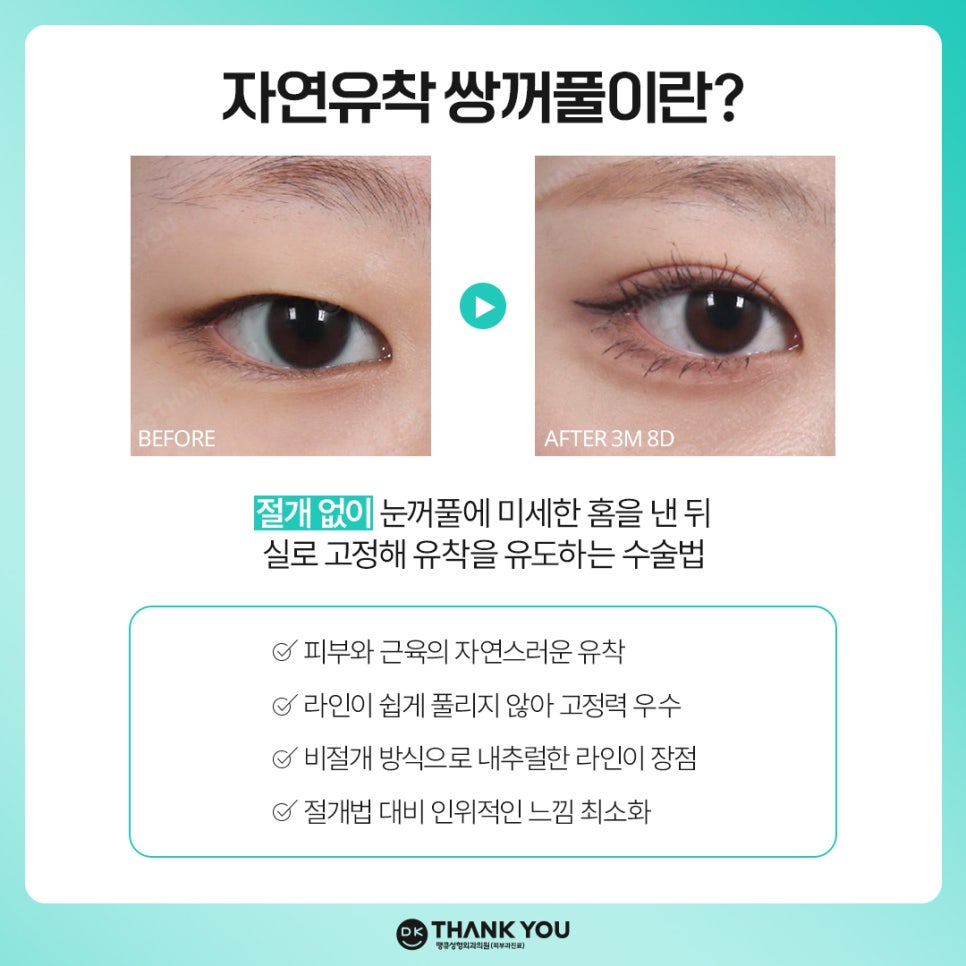 자연유착쌍꺼풀 후기 좋은 곳 땡큐에서 예뻐질 시간💖 관련 이미지 2