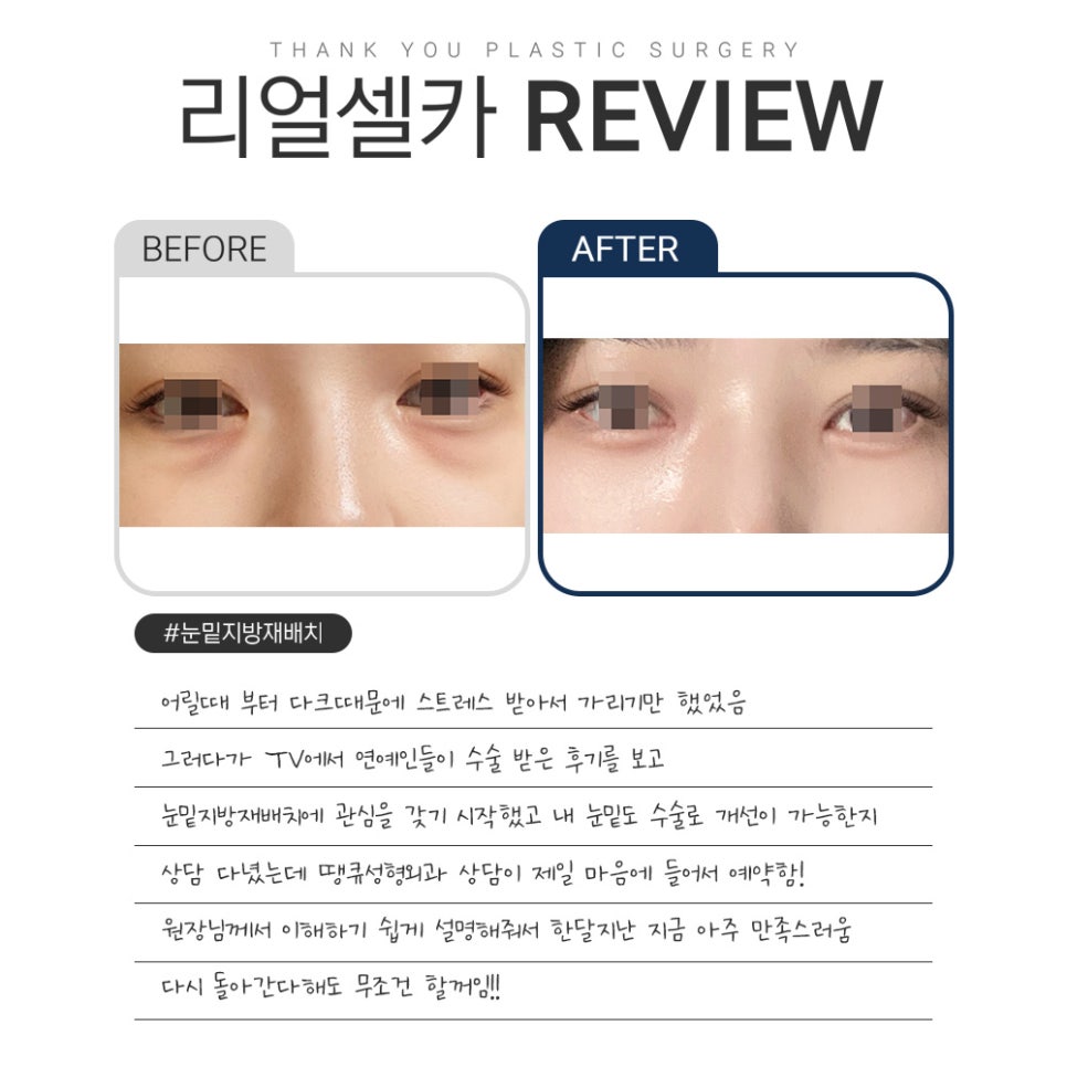 땡큐 다크서클 수술&눈밑지방재배치 리얼셀카  𝐑𝐄𝐕𝐈𝐄𝐖 관련 이미지 6