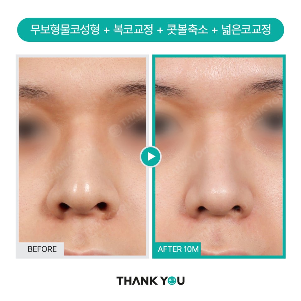 자가늑연골 코수술 장단점, 실리콘없이 무보형물 전후Check 관련 이미지 16