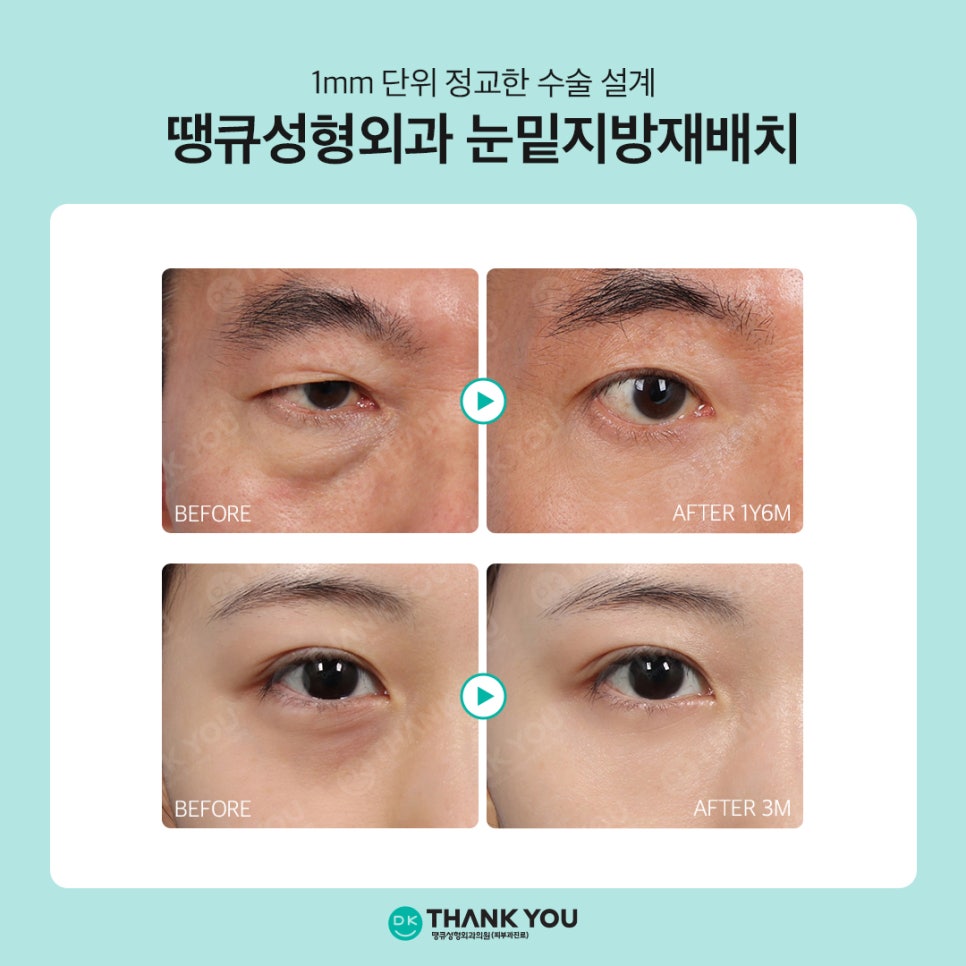 눈밑지방재배치 부작용 예방? 핵심은 1mm의 수술 설계 관련 이미지 6