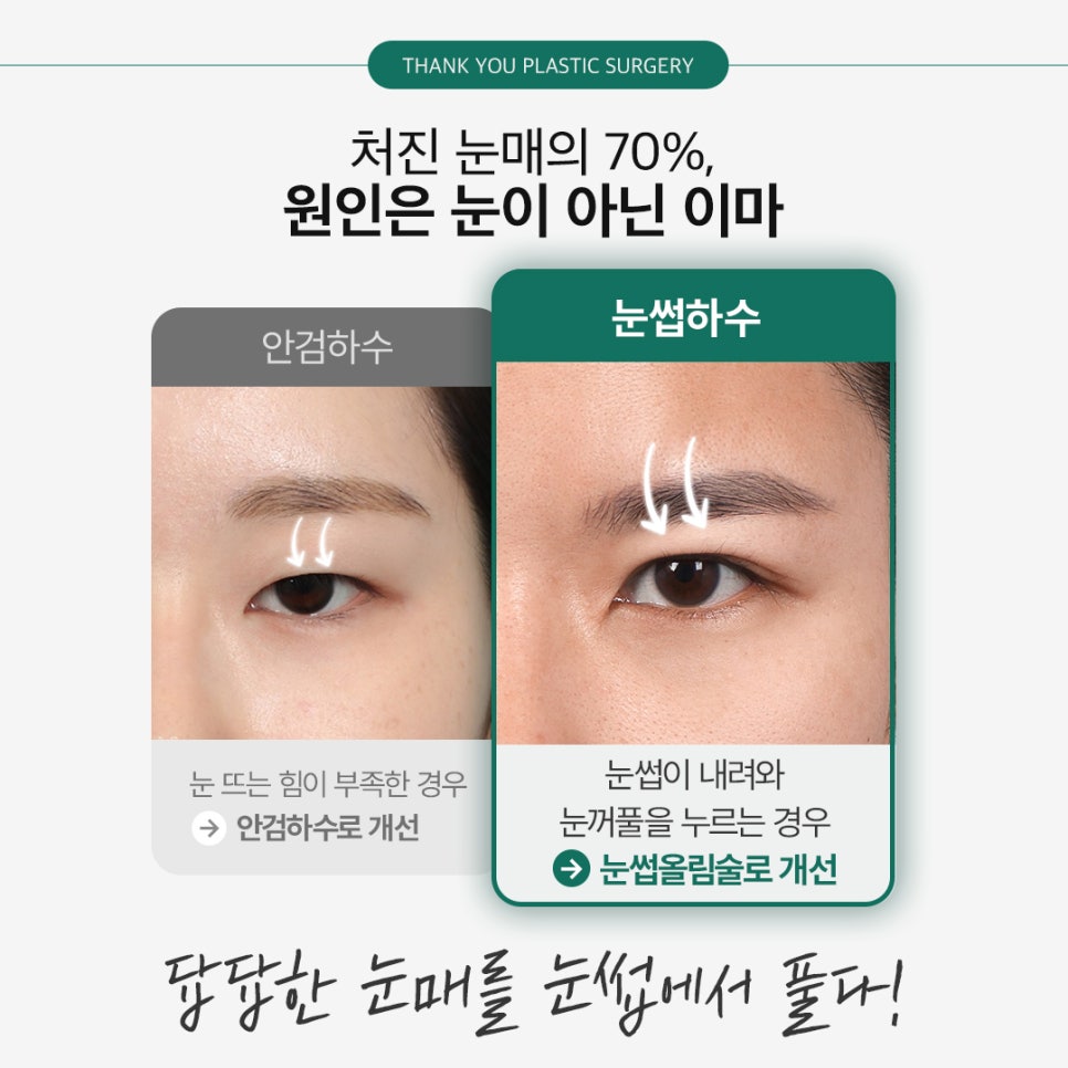 Improving Drooping, Tired-Looking Eyes in One Go with Forehead Lift Surgery! image 2