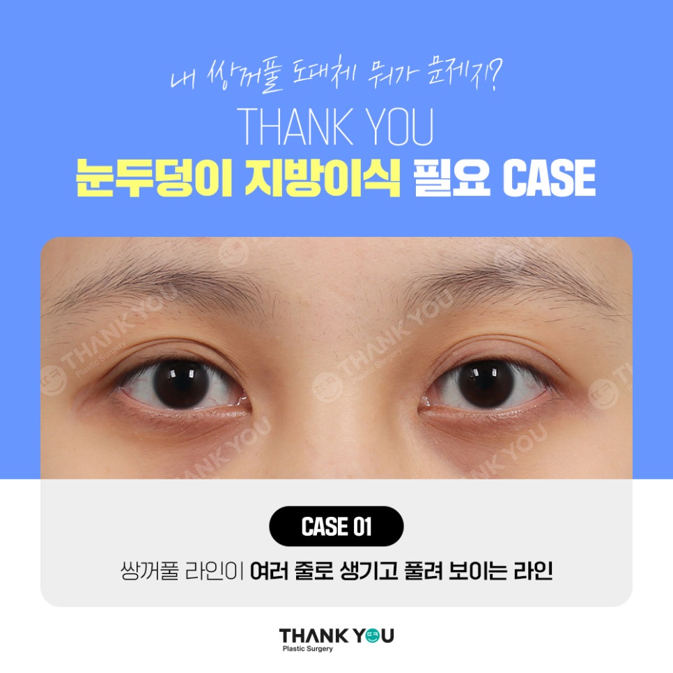 눈두덩이 지방이식, 푹꺼진 눈꺼풀에 자가지방이식으로 관련 이미지 5