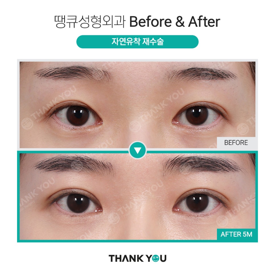 실패한 쌍수(겹주름) 눈성형 재수술 전후 사진 Point✨ 관련 이미지 6