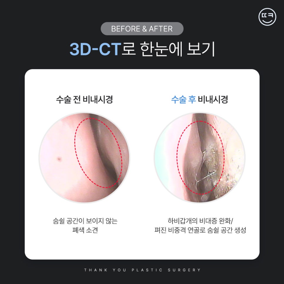 [맥미남 병원] 남자 휜코 성형, 막힌코수술, 코막힘 등 전후 까지 관련 이미지 12