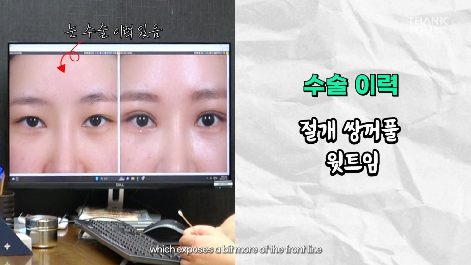 쌍수에 눈썹올림술을 추천하는 이유?! 관련 이미지 3